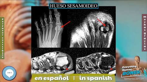 huesos sesamoideos-4